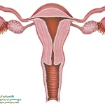 انسداد لوله رحم