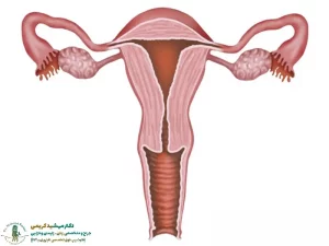 انسداد لوله رحم