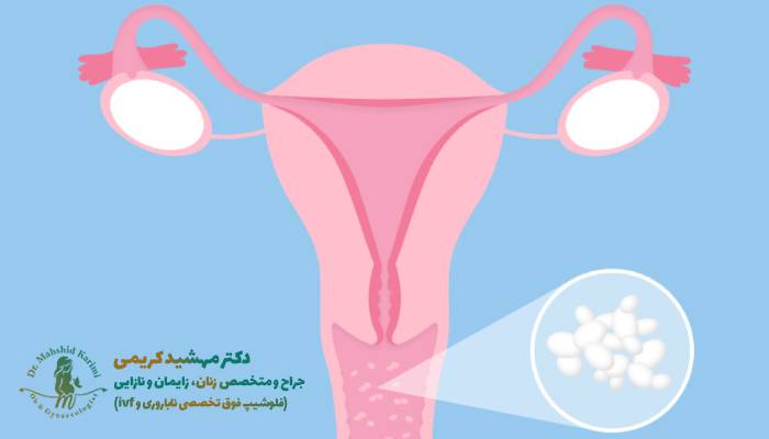 درمان عفونت مکرر واژن