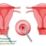 علت زخم دهانه رحم