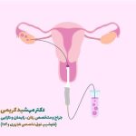 تخمک‌کشی در IVF چیست؟