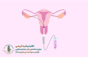 تخمک‌کشی در IVF چیست؟