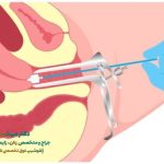 کولپوسکوپی رحم چگونه انجام میشود؟