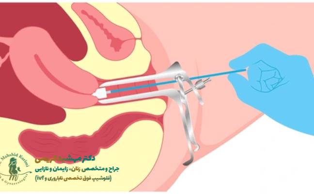 کولپوسکوپی رحم چگونه انجام میشود؟