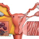 چسبندگی رحم چیست