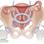 درمان غیر جراحی افتادگی رحم